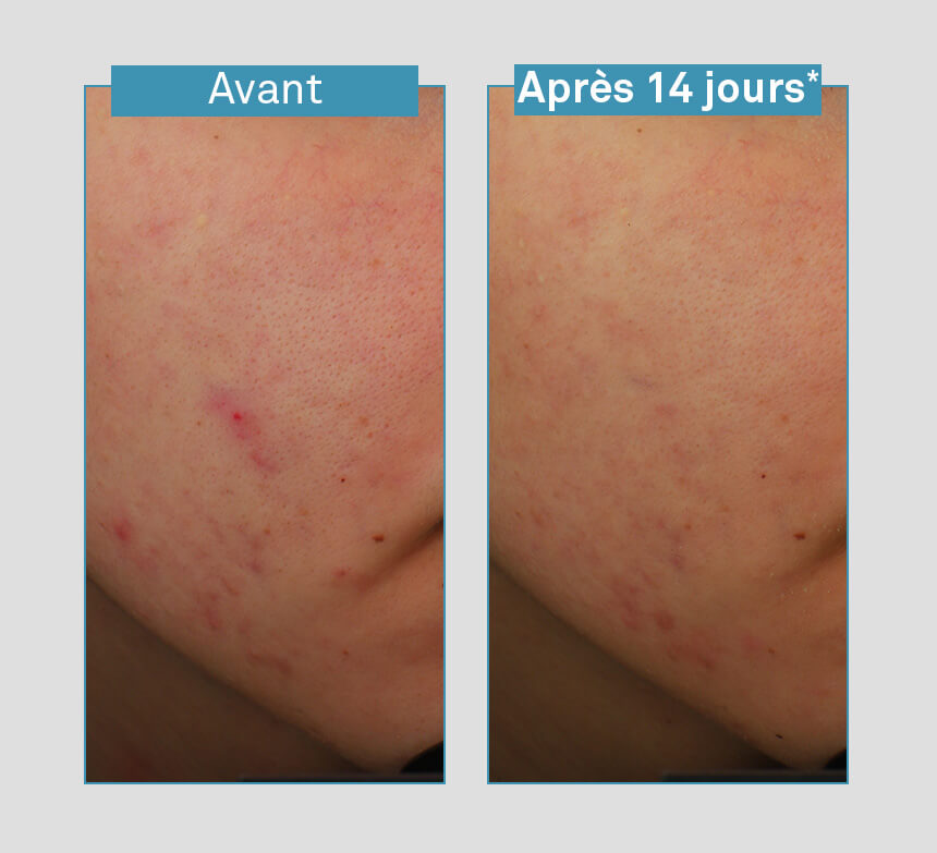 Luxéol Sérum Visage Anti-imperfections 5en1 Peaux Mixtes à Grasses à Tendance Acnéique