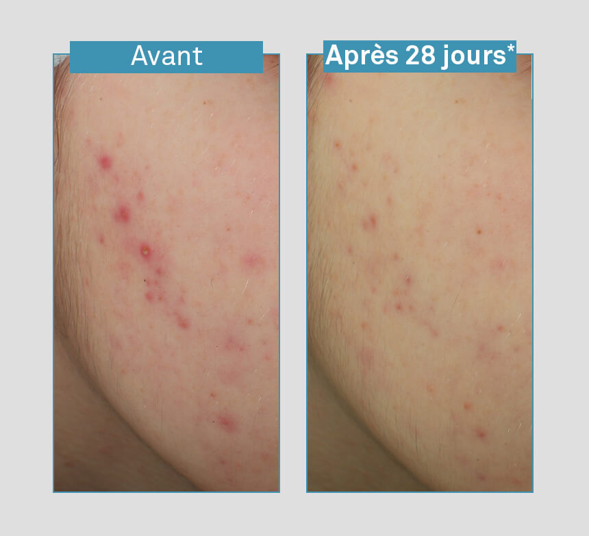 Luxéol Sérum Visage Anti-imperfections 5en1 Peaux Mixtes à Grasses à Tendance Acnéique