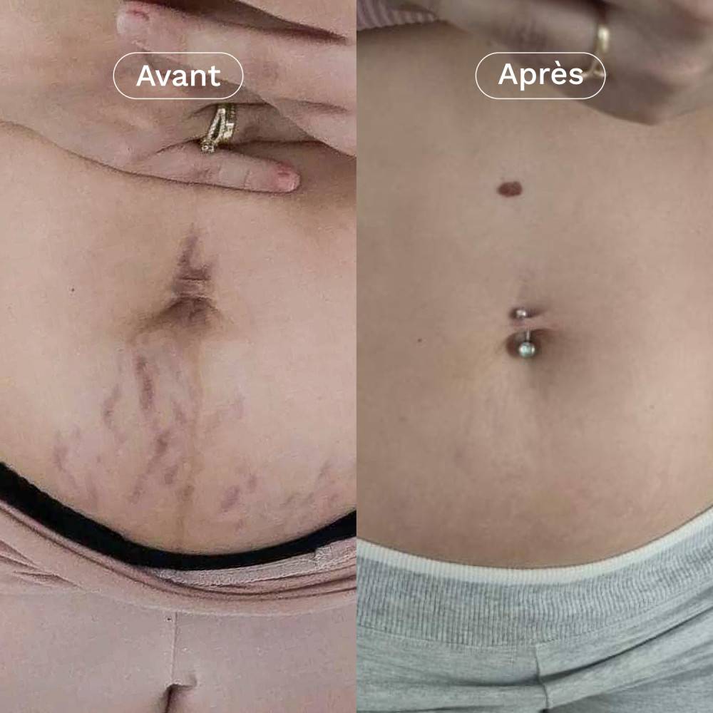 Omum Crème Contre Les Vergetures - 100ML