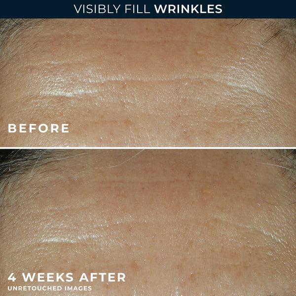 Roc RETINOL CORREXION® Deep Wrinkle Filler